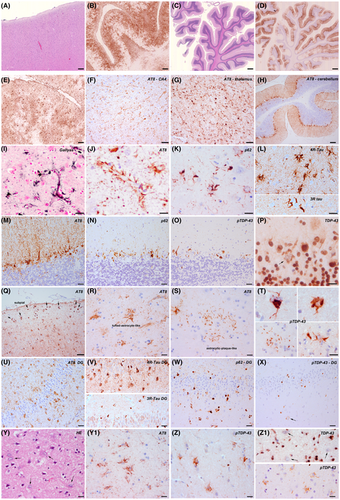 Atypical astroglial pTDP-43 pathology in astroglial predominant tauopathy.