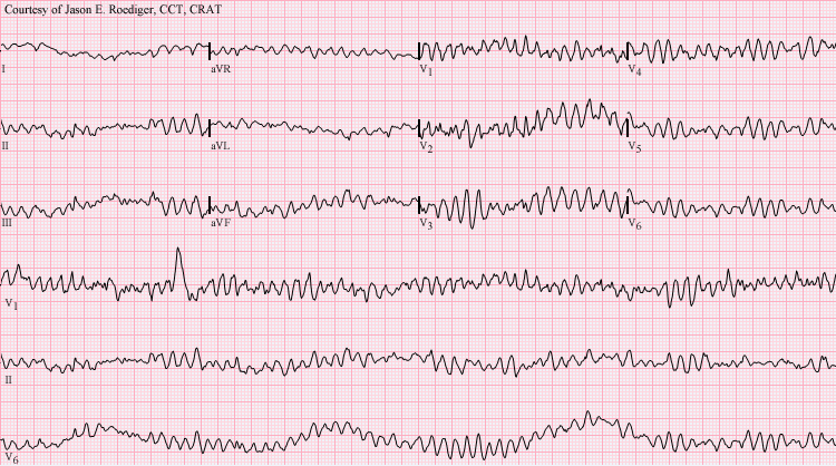 fibrilacio ventricular