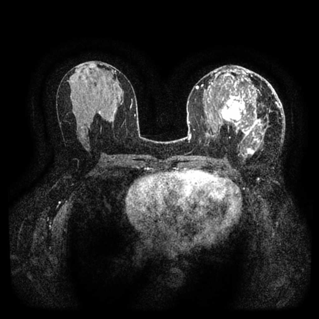 Post-contrast MRI