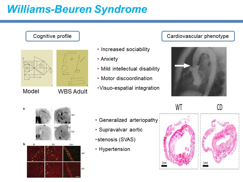 Beste Genetic diseases of connective tissue: Williams syndrome. PI FS-03